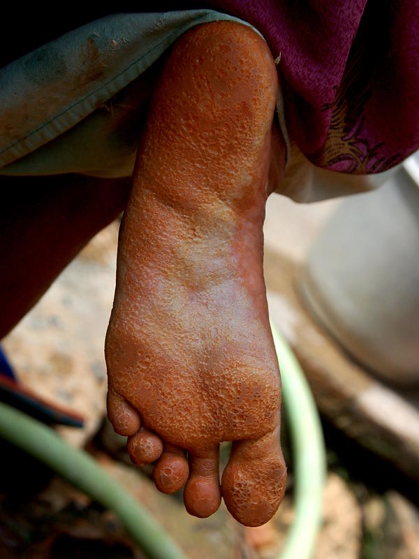 Photographer:Frida | Diseases, like this skin illness, are getting a big problem